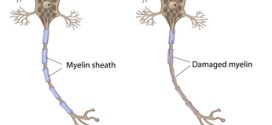 Esclerosis lateral amiotrófica – ELA