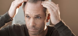 Soluciones para la alopecia