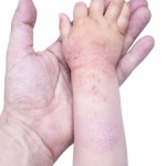 Dermatitis atópica en nilos